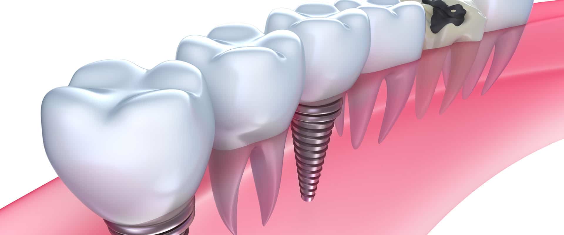 Everything You Need to Know About Dental Implants