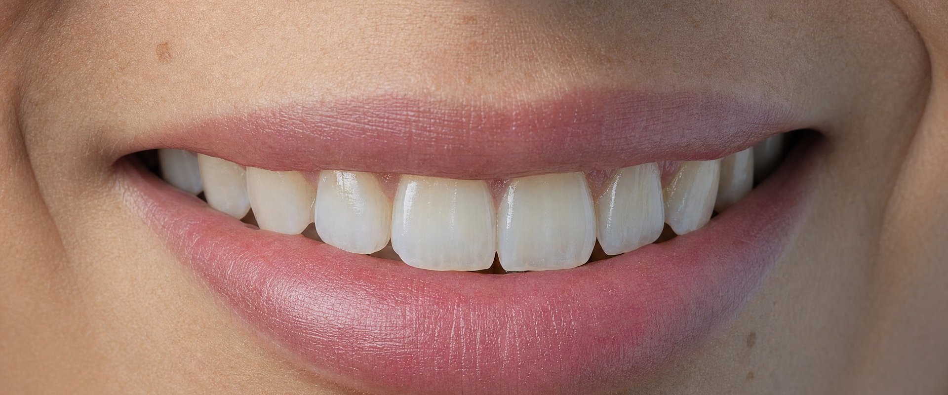 Replacing a Front Tooth: Why an Anterior Implant Is Different From Any Other Implant