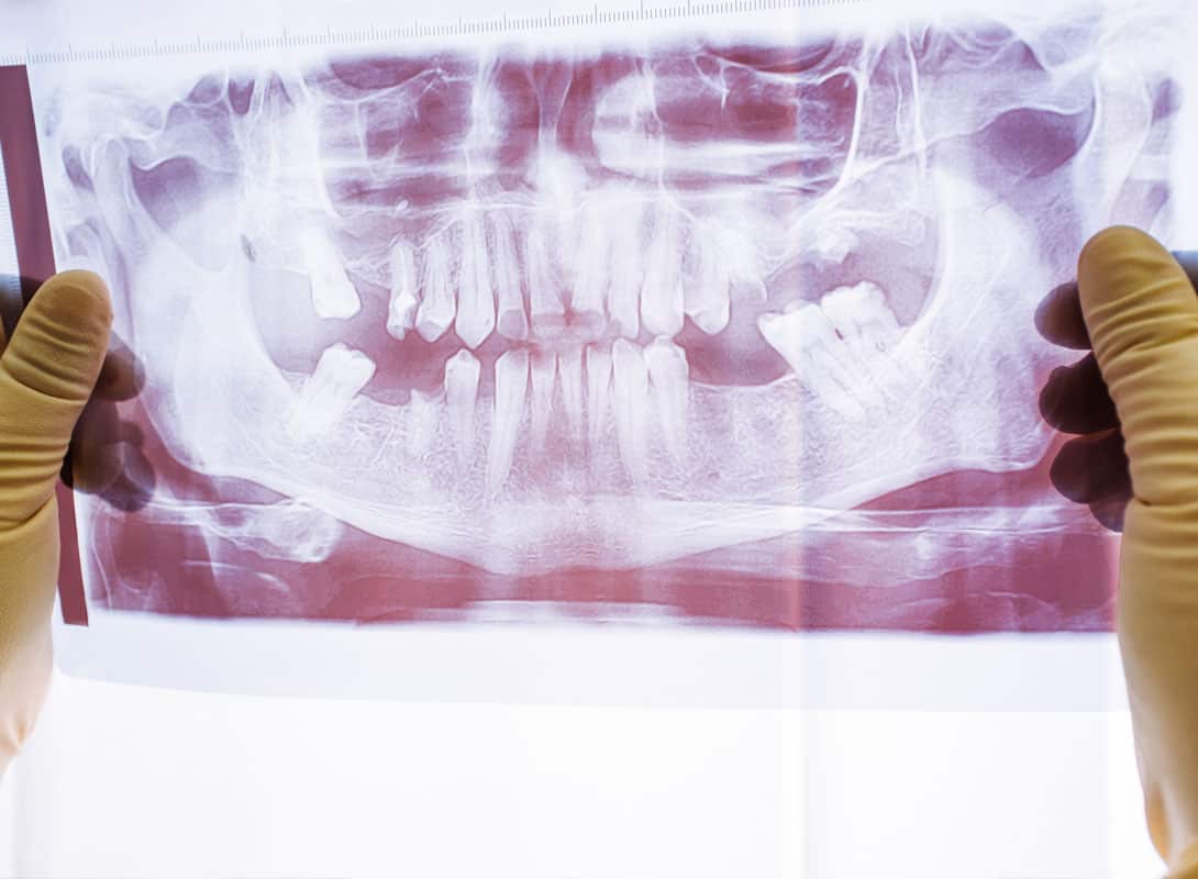 Periodontal Disease and the Body