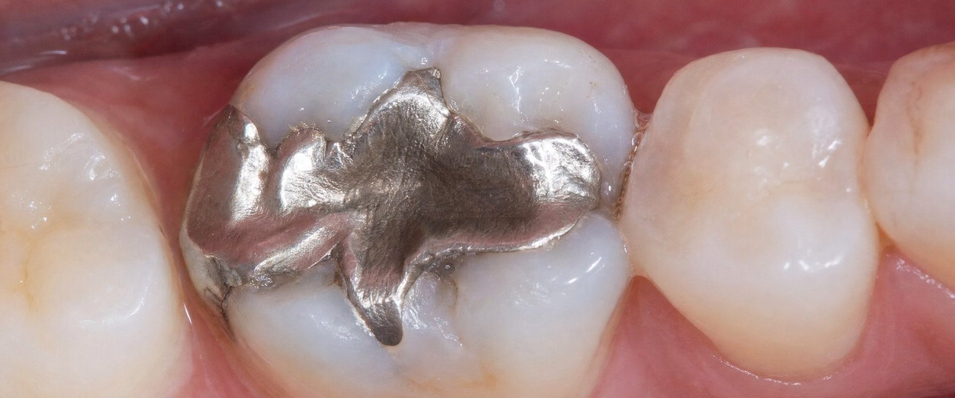 Old Silver Fillings Starting to Show? What to Know Before Replacing Amalgam With Tooth-Colored Composite