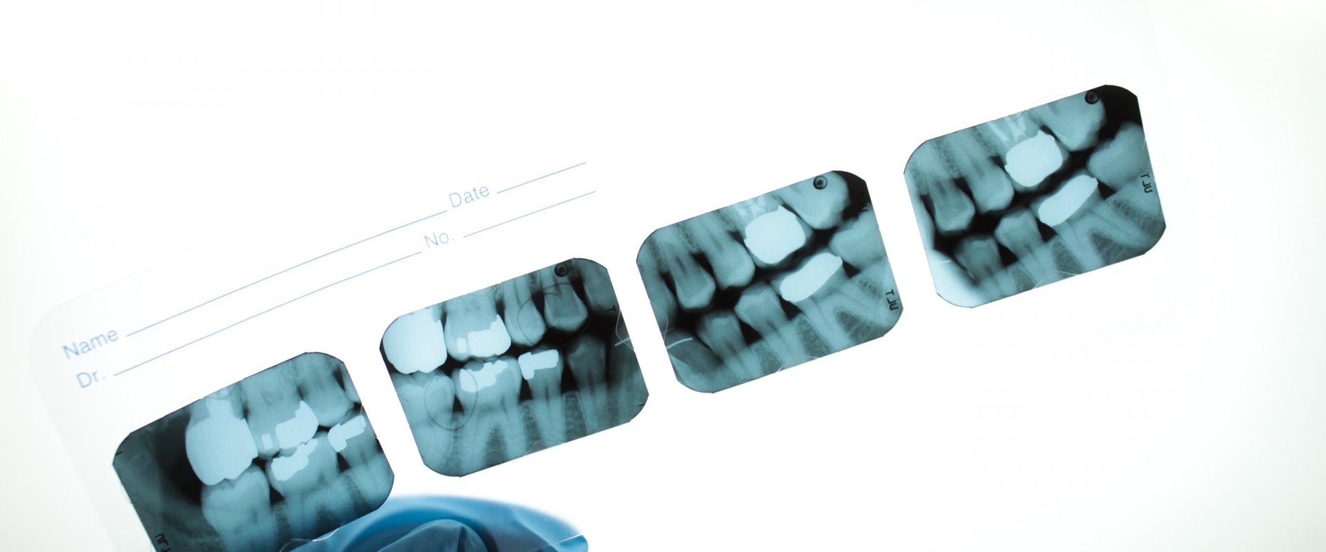 Root Canal Myths vs. Reality: Why the Procedure Is Nothing Like You''ve Heard