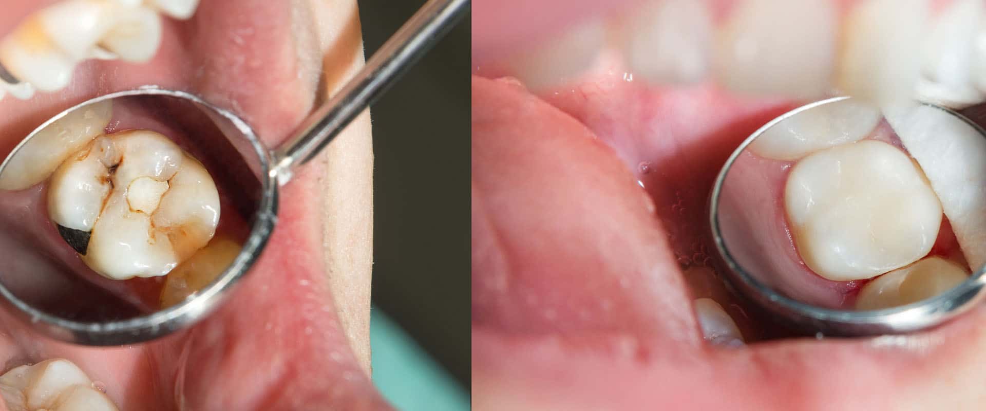 Why You Will Love Natural, White Fillings that Look and Feel Like Your Own Teeth 