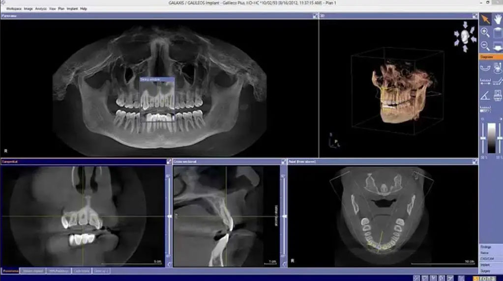 Professional Dental Implants Technology