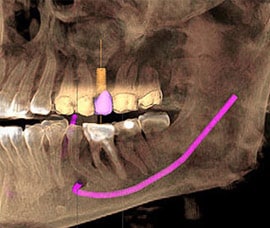 Dental Implant Dentist